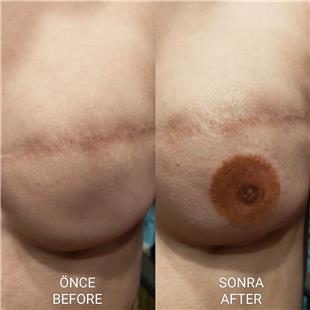 Meme Kanseri Nedeniyle Mastektomi Sonras Meme Ucu Areola Dvmesi / Nipple Areola Tattoo