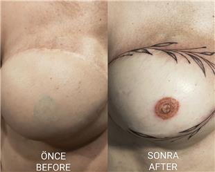 Meme Kanseri Nedeniyle Mastektomi Sonras Meme Ucu Areola Dvmesi / Nipple Areola Tattoo